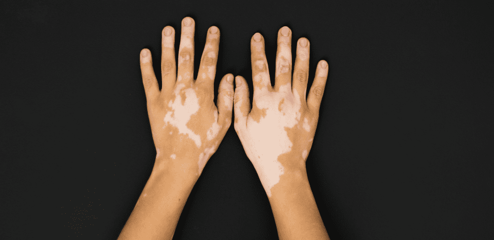 Por que o Vitiligo causa manchas na pele?